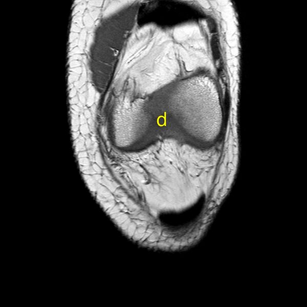 File:Anatomy Quiz (MRI knee) (Radiopaedia 43478-46874 A 5).jpeg