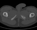 Aneurysmal bone cyst of ischium (Radiopaedia 25957-26094 Axial bone window 80).png