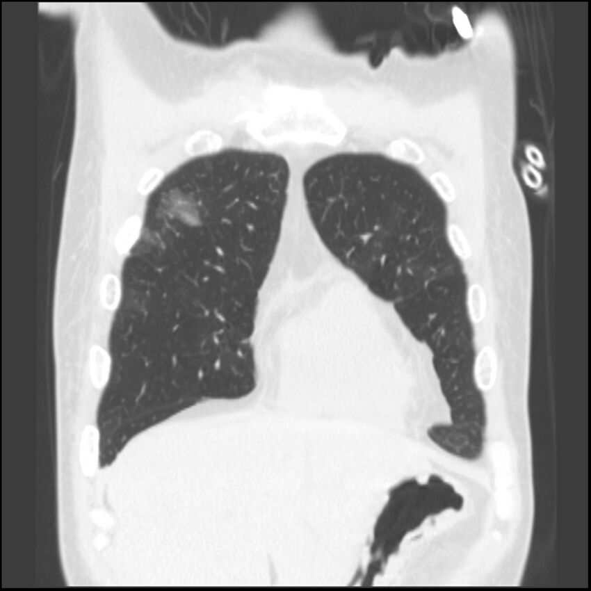 Angioinvasive aspergillosis (Radiopaedia 43957-47466 Coronal lung window 75).jpg