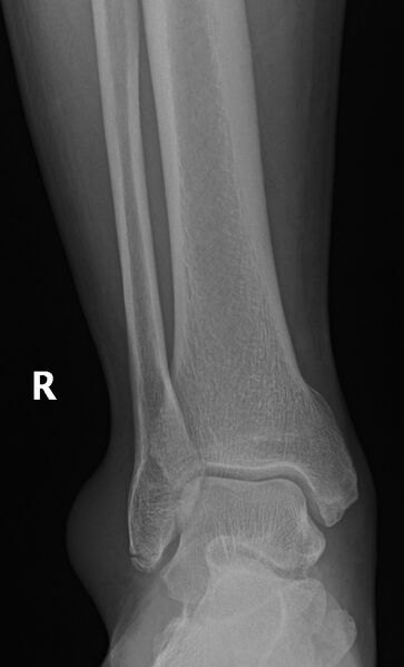 File:Ankle fracture - Weber A (Radiopaedia 9680-10306 Lateral 1).jpg