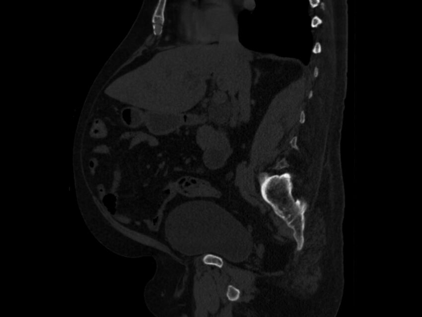 Ankylosing spondylitis (Radiopaedia 44609-48357 Sagittal bone window 43).jpg