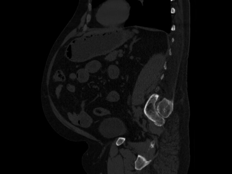 File:Ankylosing spondylitis (Radiopaedia 44609-48357 Sagittal bone window 70).jpg