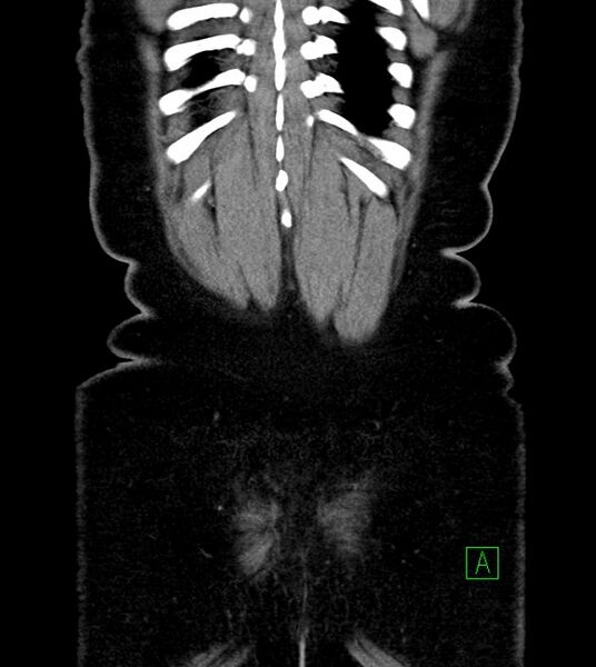 File:Anterior abdominal wall CSF pseudocyst (CSFoma) (Radiopaedia 79453-92571 B 51).jpg