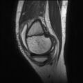 Anterior cruciate ligament tear - pediatric (Radiopaedia 62152-70260 Sagittal PD 39).jpg