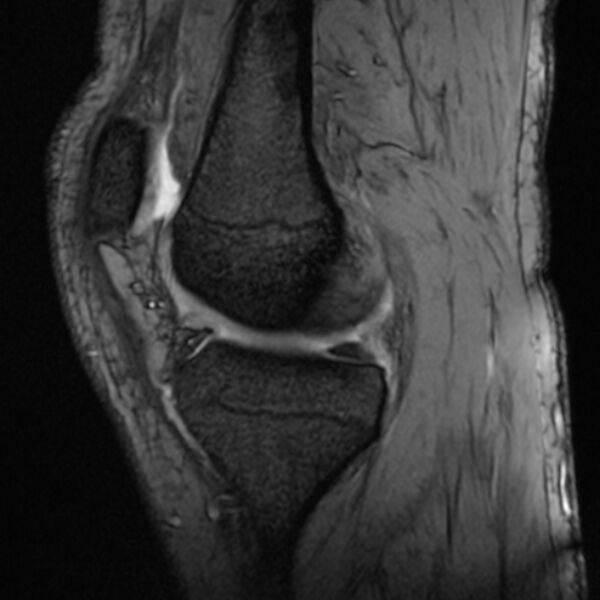 File:Anterior cruciate ligament tear - ramp lesion (Radiopaedia 71883-82322 Sagittal T2 fat sat 16).jpg
