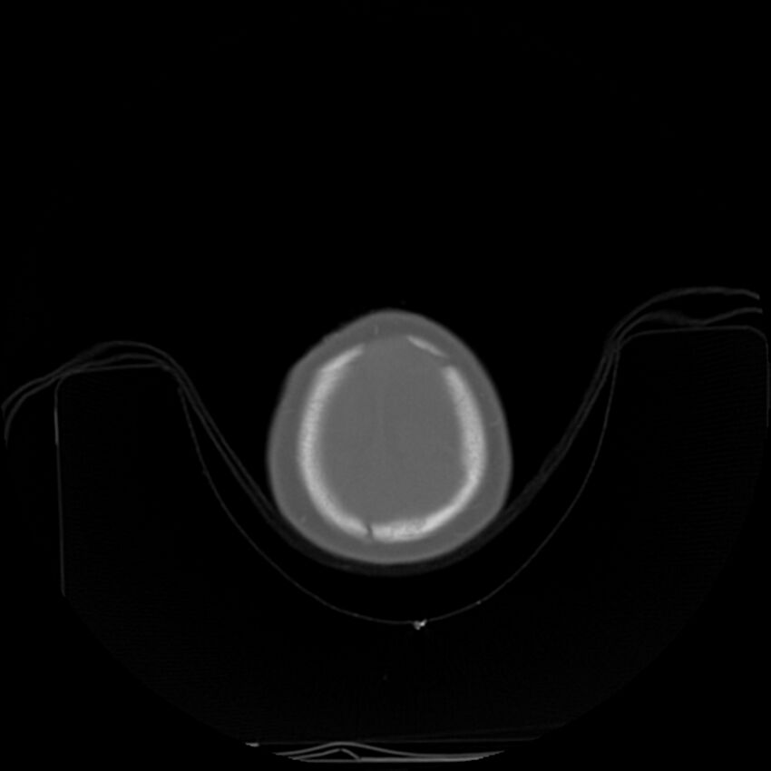 Anterior plagiocephaly (Radiopaedia 71836-82273 C 98).jpg
