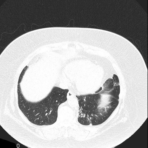 File:Aortic arch false aneurysm (Radiopaedia 14667-14587 Axial lung window 17).jpg