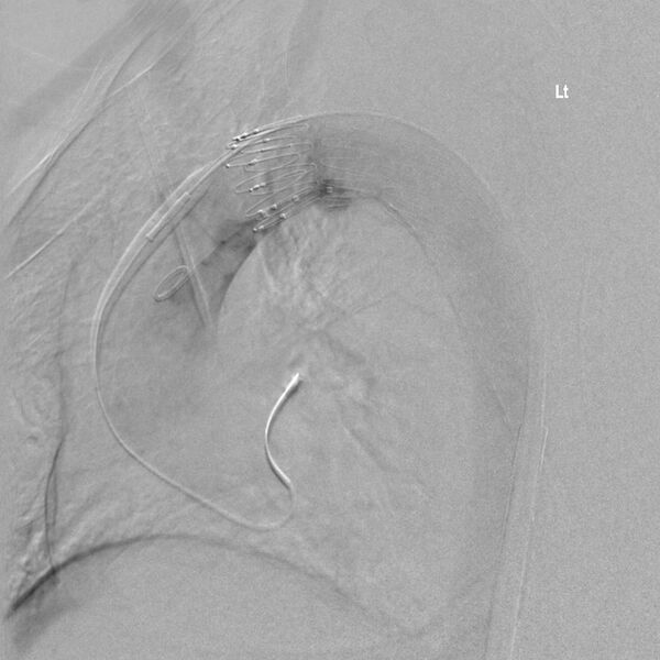 File:Aortic arch false aneurysm (Radiopaedia 14667-14589 Final result 6).jpg