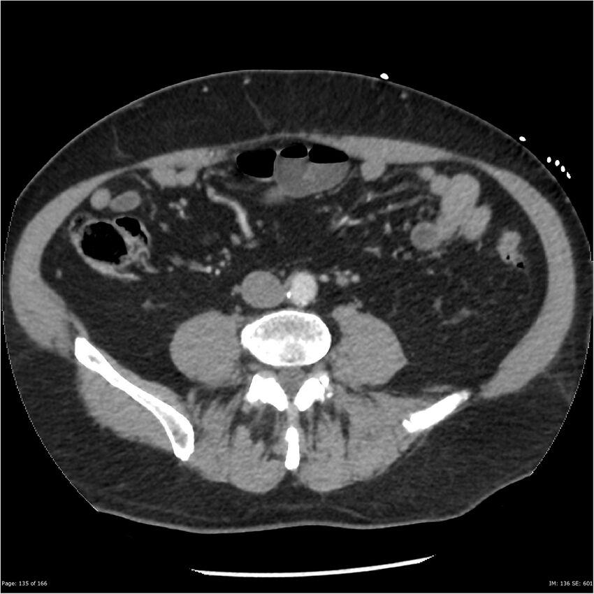 Aortic dissection- Stanford A (Radiopaedia 37759-39664 A 126).jpg
