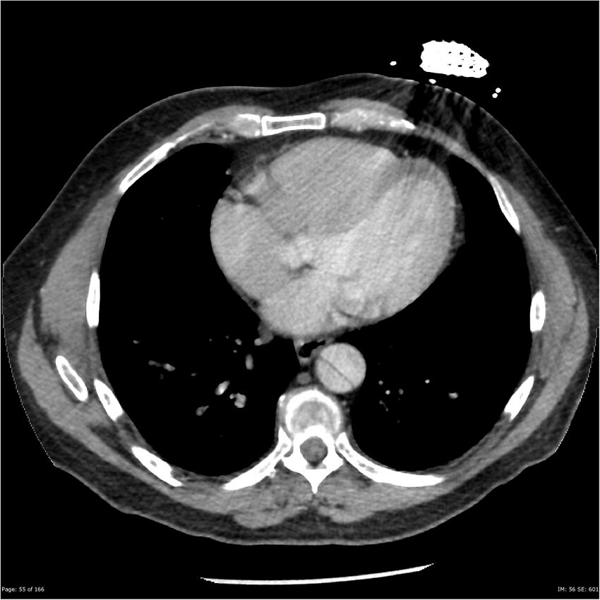 Aortic dissection- Stanford A (Radiopaedia 37759-39664 A 46).jpg