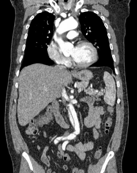 File:Aortic dissection (Radiopaedia 44411-48061 A 18).jpg