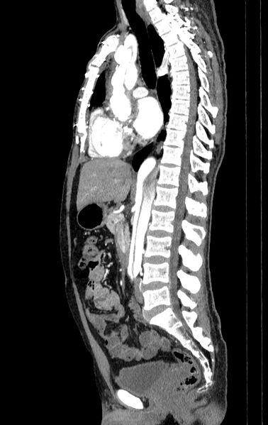 File:Aortic dissection - Stanford type A (Radiopaedia 83418-98500 B 32).jpg