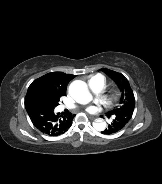 File:Aortic dissection with renal ischemia (Radiopaedia 76573-88338 A 33).jpg