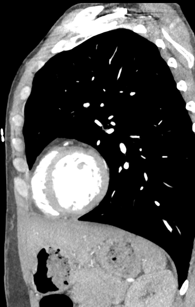 File:Aortic valve non-coronary cusp thrombus (Radiopaedia 55661-62189 C+ arterial phase 13).png