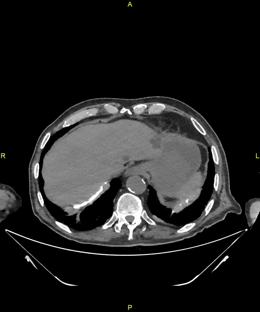 Aortoenteric fistula (Radiopaedia 84308-99603 Axial non-contrast 29).jpg