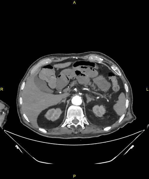 File:Aortoenteric fistula (Radiopaedia 84308-99603 B 75).jpg