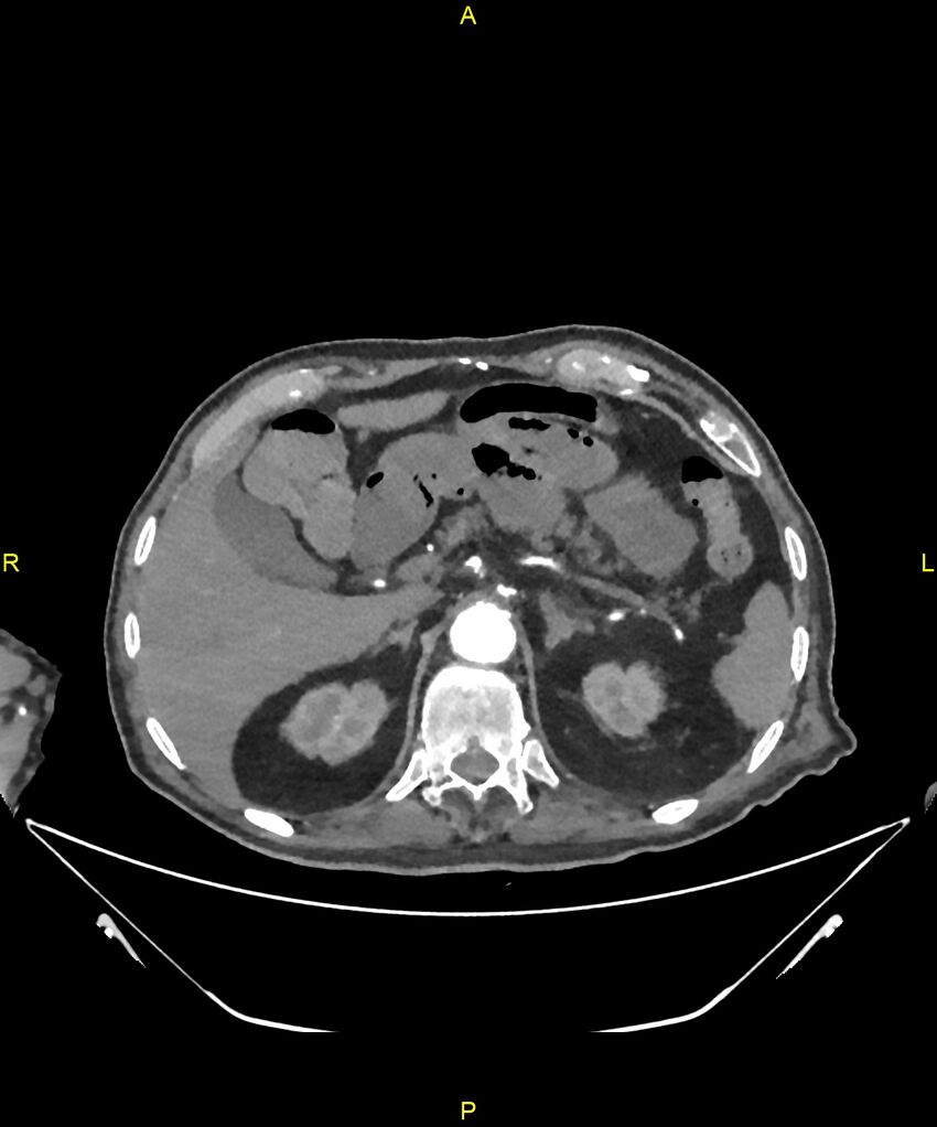 Aortoenteric fistula (Radiopaedia 84308-99603 B 75).jpg