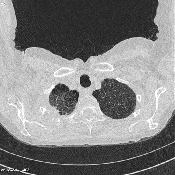 File:Apical non-small-cell lung cancer (Radiopaedia 8570-9405 Axial lung window 4).jpg