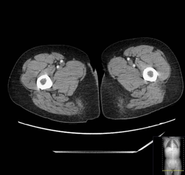 File:Appendicitis (CT angiogram) (Radiopaedia 154713-127660 Axial 132).jpg