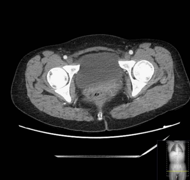 File:Appendicitis (CT angiogram) (Radiopaedia 154713-127660 Axial 72).jpg