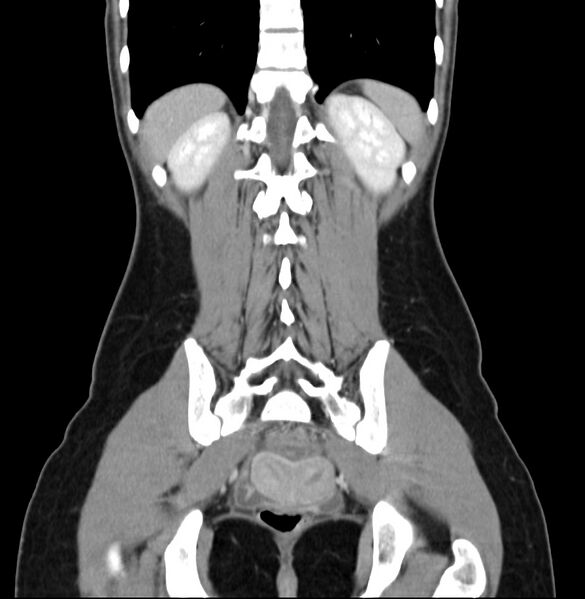 File:Appendicitis and incidental bicornuate uterus (Radiopaedia 22833-22853 D 36).jpg