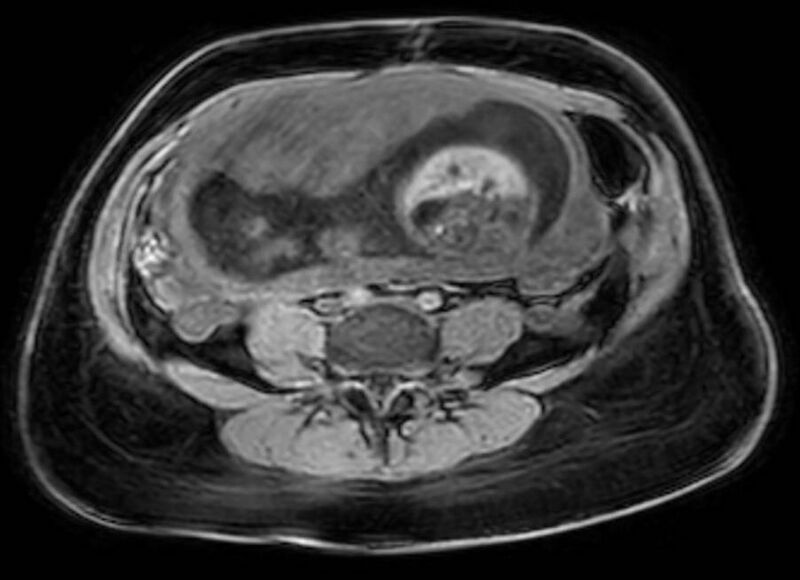 File:Appendicitis in gravida (MRI) (Radiopaedia 89433-106395 Axial DIXON 89).jpg