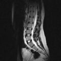 Arachnoid cyst - spinal (Radiopaedia 66835-76157 Sagittal T2 5).jpg