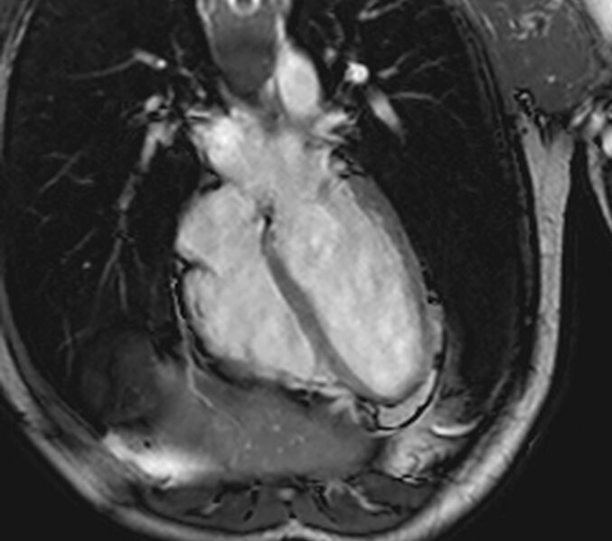 File:Arrhythmogenic right ventricular cardiomyopathy (Radiopaedia 39806-42237 D 105).jpg