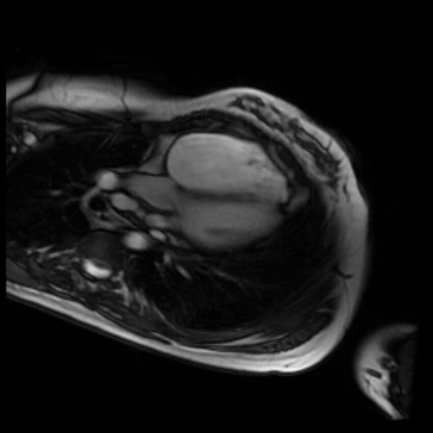 Arrhythmogenic right ventricular cardiomyopathy (Radiopaedia 87505-103850 4ch Cine SSFP 2).jpg