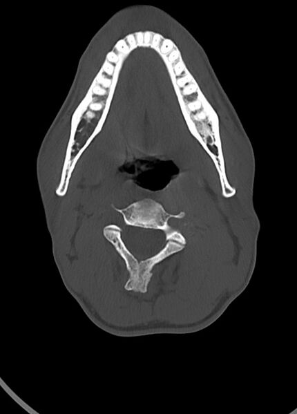 File:Arrow injury to the head (Radiopaedia 75266-86388 Axial bone window 22).jpg