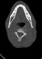 Arrow injury to the head (Radiopaedia 75266-86388 Axial bone window 22).jpg