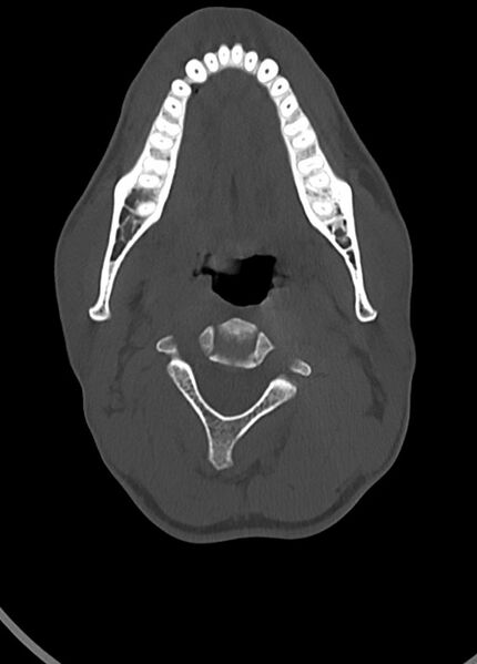 File:Arrow injury to the head (Radiopaedia 75266-86388 Axial bone window 24).jpg