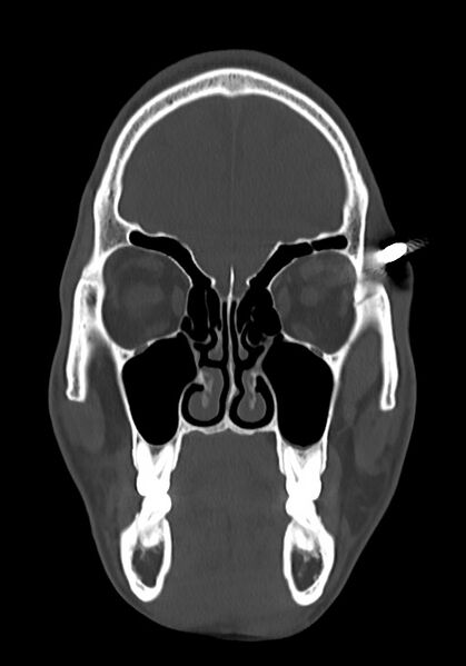 File:Arrow injury to the head (Radiopaedia 75266-86388 Coronal bone window 30).jpg