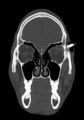 Arrow injury to the head (Radiopaedia 75266-86388 Coronal bone window 30).jpg
