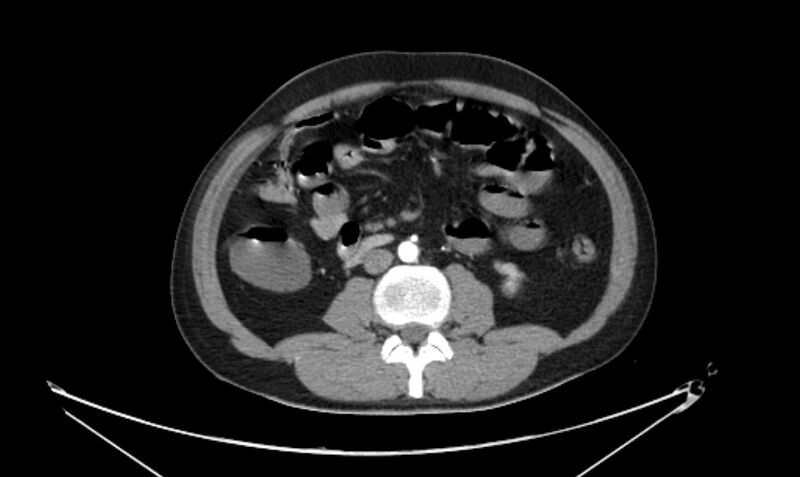File:Arterial occlusive mesenteric ischemia (Radiopaedia 84641-100060 A 69).jpg