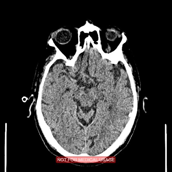File:Artery of Percheron infarction (Radiopaedia 28679-28967 Axial non-contrast 49).jpg