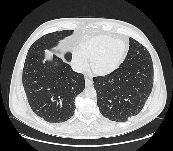 File:Asbestos pleural placques (Radiopaedia 57905-64872 Axial lung window 176).jpg