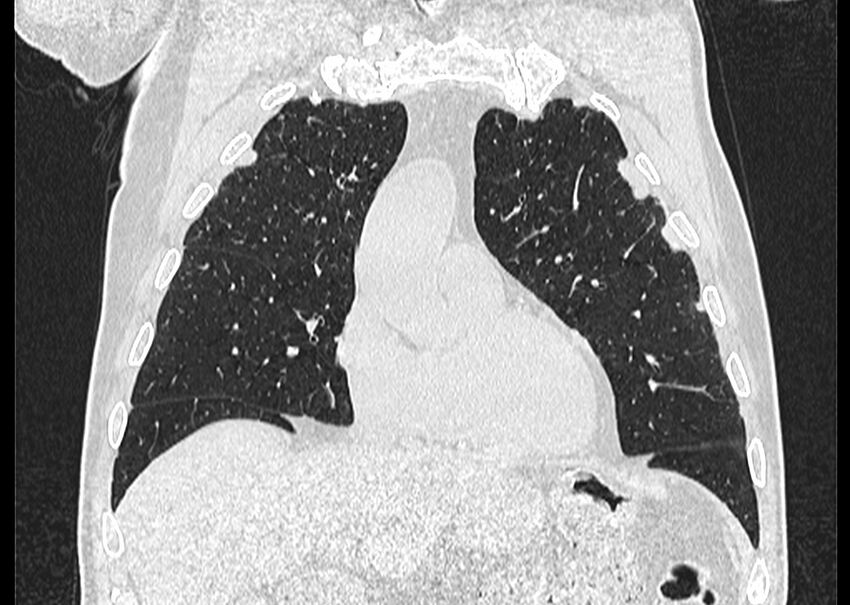 Asbestos pleural placques (Radiopaedia 57905-64872 Coronal lung window 84).jpg