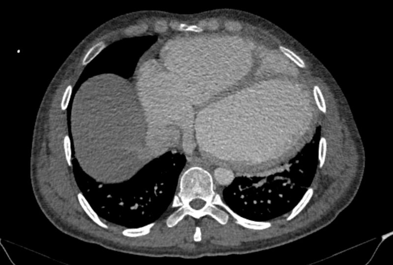 File:Ascending aortic aneurysm (Radiopaedia 86279-102297 C 48).jpg