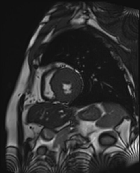 File:Asymmetric septal hypertrophic cardiomyopathy - systolic anterior motion of mitral leaflet (Radiopaedia 72795-83445 C 15).jpg