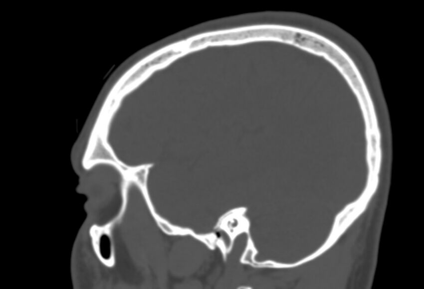 Asymptomatic occipital spur (Radiopaedia 87753-104201 Sagittal bone window 238).jpg