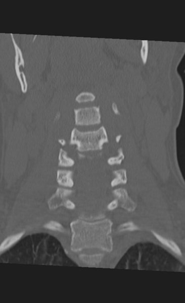File:Atlanto-occipital dissociation (Radiopaedia 33848-35013 Coronal bone window 16).png