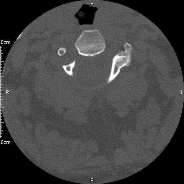File:Atlas fracture with Currarino type A congenital defect (Radiopaedia 71747-82144 Axial bone window 62).jpg