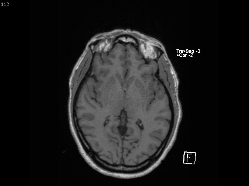 Atypical meningioma - intraosseous (Radiopaedia 64915-74572 Axial T1 112).jpg