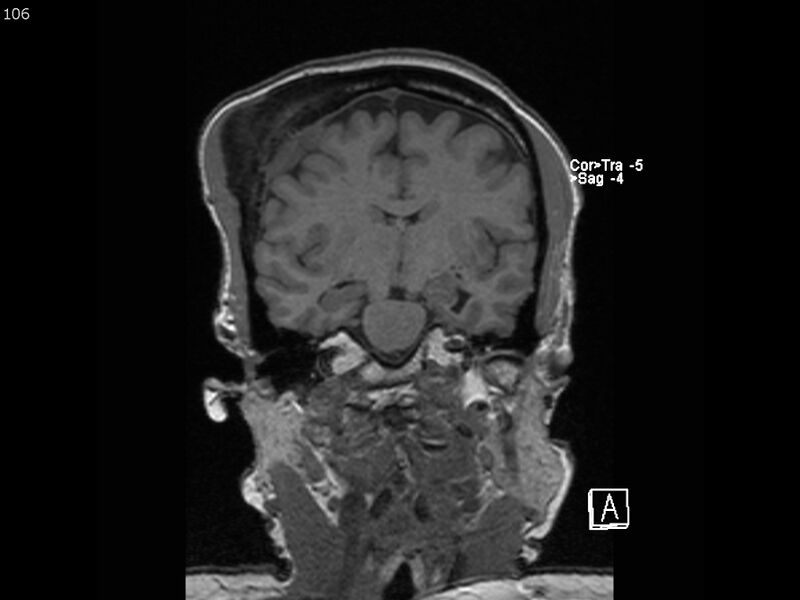 File:Atypical meningioma - intraosseous (Radiopaedia 64915-74572 Coronal T1 106).jpg
