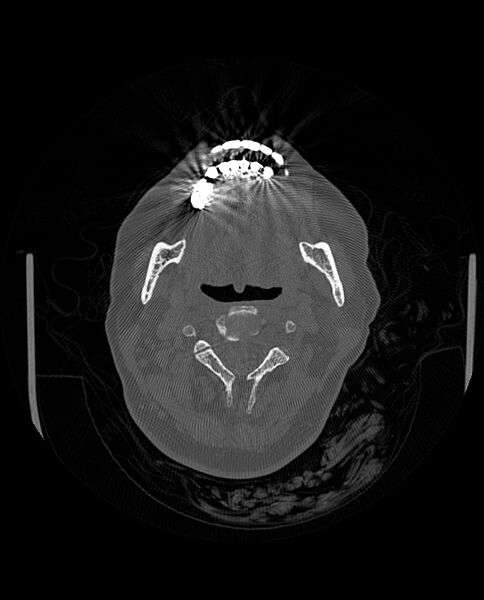 File:Automastoidectomy with labyrinthine fistula (Radiopaedia 84143-99411 Axial non-contrast 1).jpg
