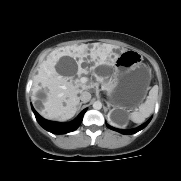 File:Autosomal dominant polycystic kidney disease (Radiopaedia 23061-23093 C 17).jpg
