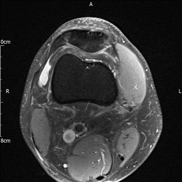 File:Avulsion fracture of the fibular head (Radiopaedia 74804-85808 Axial PD fat sat 5).jpg