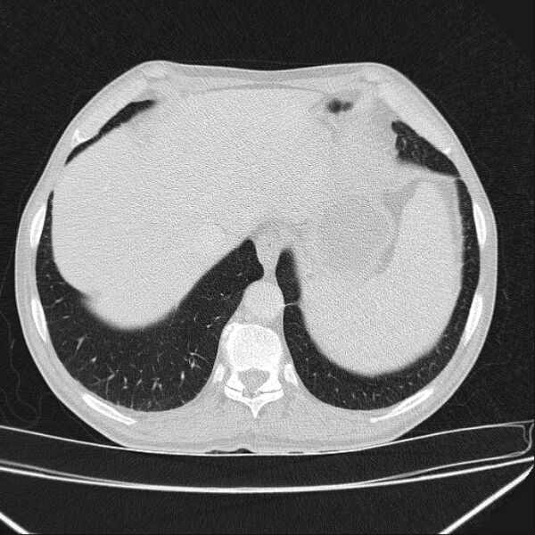 File:Azygos lobe (Radiopaedia 38259-40275 Axial lung window 70).jpg