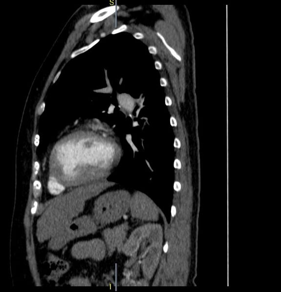 File:Azygos vein aneurysm (Radiopaedia 77824-90130 D 12).JPG